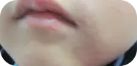 幼儿面部白癜风治疗前图片