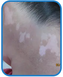 幼儿颈部白斑康复案例图片