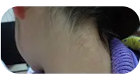 幼儿颈部白癜风治疗后图片