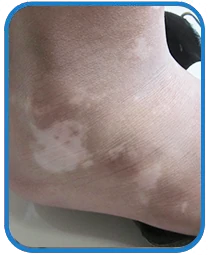 幼儿四肢白斑康复案例图片图片