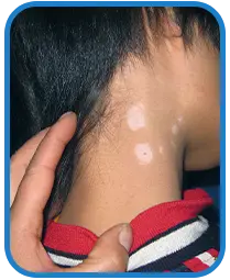儿童颈部白癜风白斑治疗案例图片