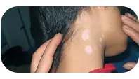 儿童颈部白斑治疗前图片