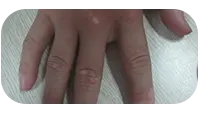 儿童手部白斑治疗中图片