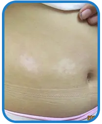 儿童腹部白癜风白斑治疗案例图片
