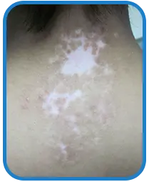 儿童背部白癜风白斑治疗案例图片