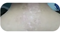 儿童背部白斑治疗中图片