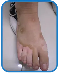 儿童脚部白癜风白斑治疗案例图片