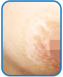 青少年胸部白癜风白斑治疗案例图片