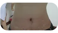 青少年腹部白癜风治疗中图片
