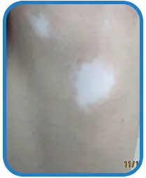 青少年腿部白癜风白斑治疗案例图片