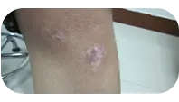 青少年腿部白癜风治疗中图片