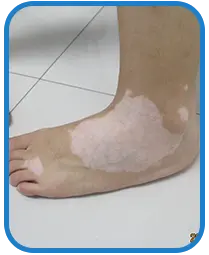 青少年脚部白癜风白斑治疗案例图片