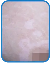 女性胸部白癜风康复案例图片