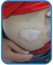 女性腹部白癜风康复案例图片