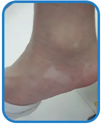 女性脚部白癜风康复案例图片