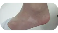 女性脚部白癜风治疗前图片
