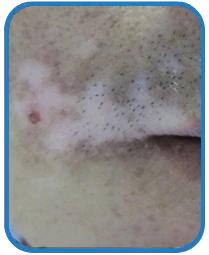 男性面部白癜风康复案例图片