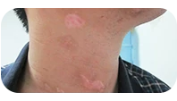 男性颈部白癜风治疗中图片