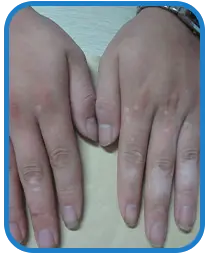 男性手部白癜风康复案例图片