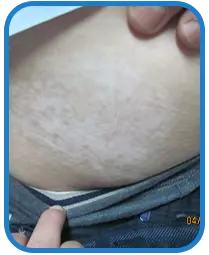 男性腹部白癜风康复案例图片