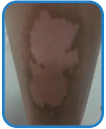 男性腿部白癜风康复案例图片