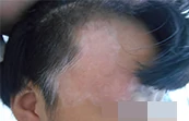 磕伤额头出现白癜风治疗中