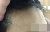 磕伤额头出现白癜风治疗后