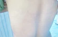 背部白癜风治疗后